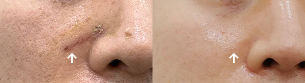 Before and after: facial depressed & incision scars
