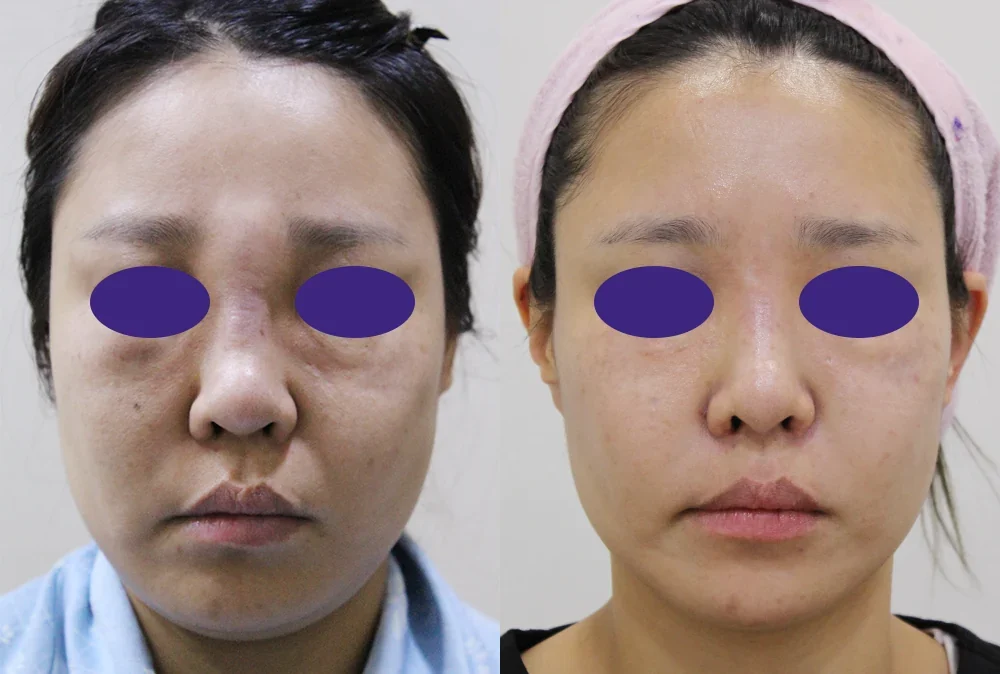 Before and after: foreign-body & filler removal