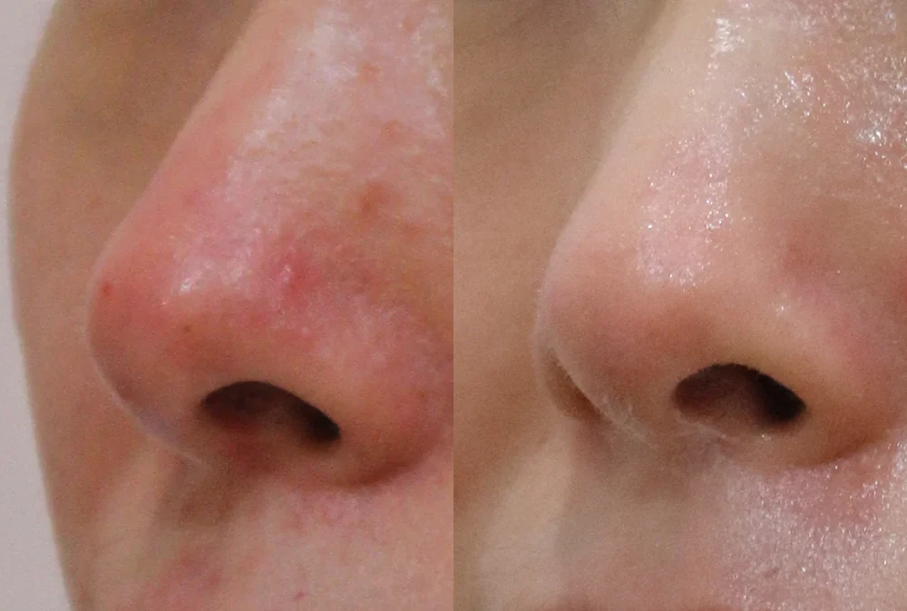 Before and after: nose scars