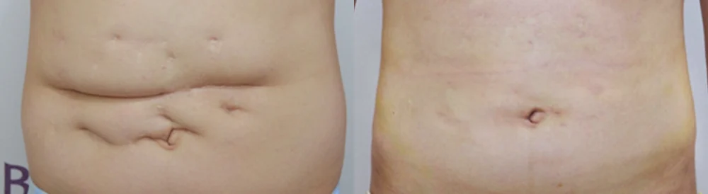 사고 흉터 시술 전후 사진 38 · 보니따의원