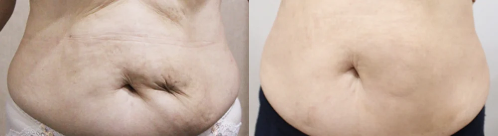 사고 흉터 시술 전후 사진 41 · 보니따의원