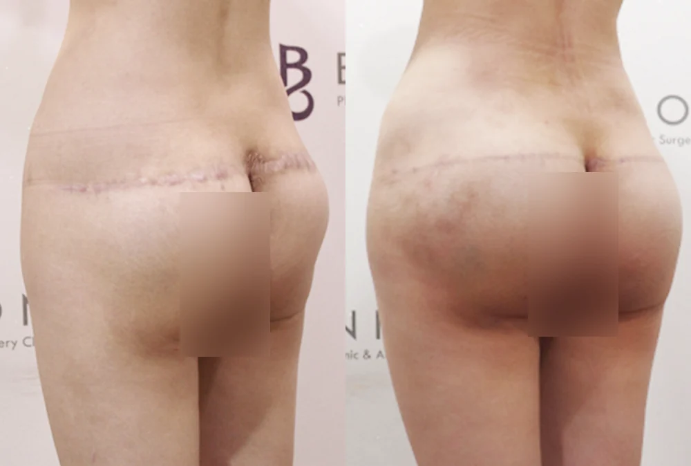 사고 흉터 시술 전후 사진 2 · 보니따의원