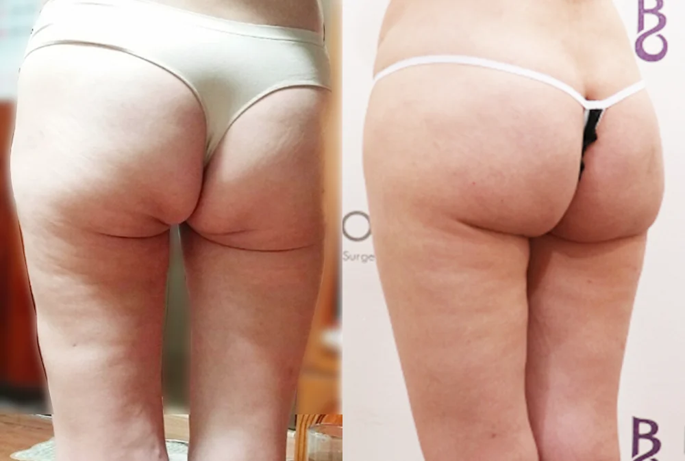 사고 흉터 시술 전후 사진 9 · 보니따의원