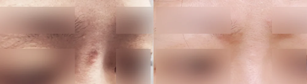 사고 흉터 시술 전후 사진 43 · 보니따의원