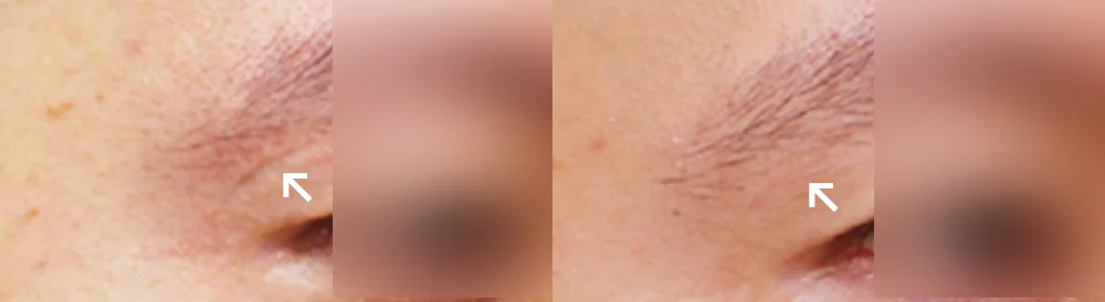 사고 흉터 시술 전후 사진 44 · 보니따의원