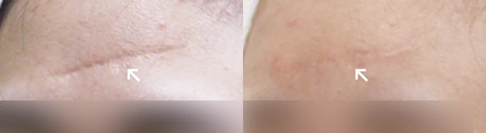 사고 흉터 시술 전후 사진 45 · 보니따의원