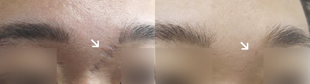 사고 흉터 시술 전후 사진 47 · 보니따의원