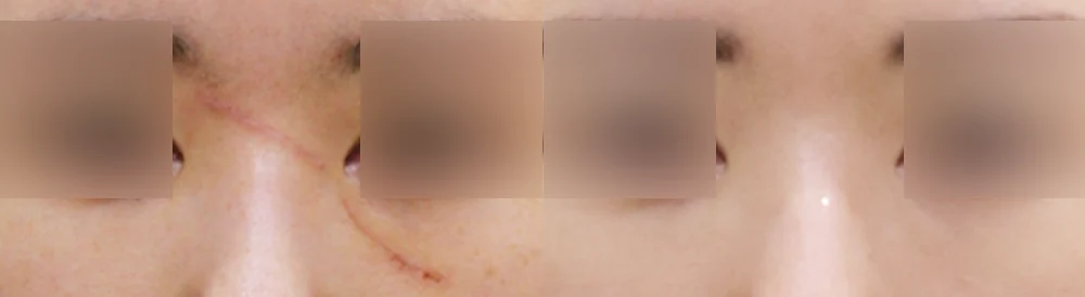 사고 흉터 시술 전후 사진 48 · 보니따의원