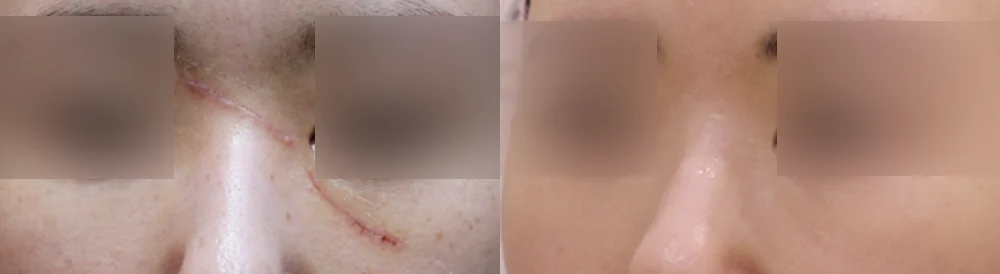 사고 흉터 시술 전후 사진 49 · 보니따의원