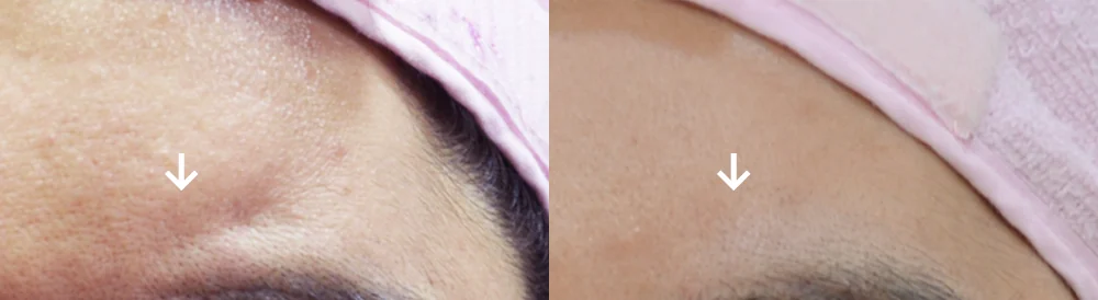 사고 흉터 시술 전후 사진 50 · 보니따의원