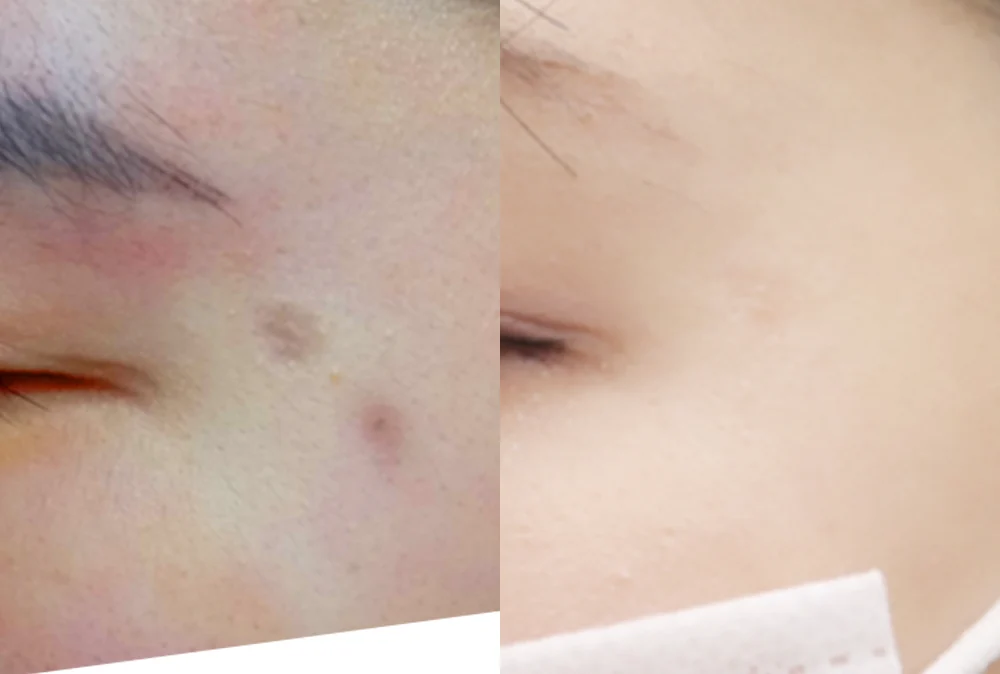 사고 흉터 시술 전후 사진 18 · 보니따의원