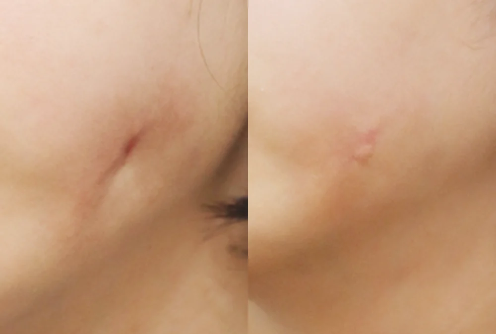 사고 흉터 시술 전후 사진 23 · 보니따의원