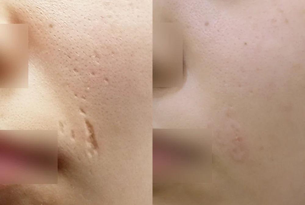 사고 흉터 시술 전후 사진 31 · 보니따의원