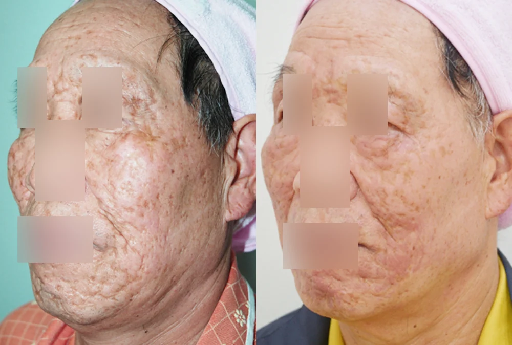 사고 흉터 시술 전후 사진 32 · 보니따의원