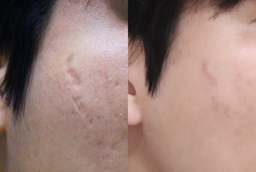 사고 흉터 시술 전후 사진 33 · 보니따의원