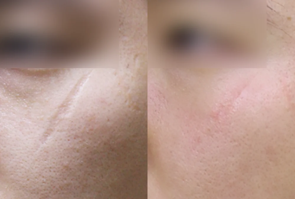 사고 흉터 시술 전후 사진 37 · 보니따의원