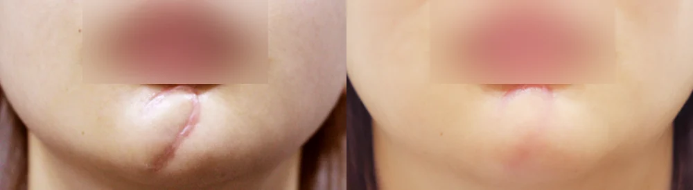 사고 흉터 시술 전후 사진 53 · 보니따의원