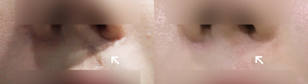 사고 흉터 시술 전후 사진 56 · 보니따의원