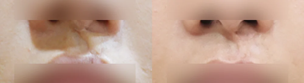 사고 흉터 시술 전후 사진 58 · 보니따의원