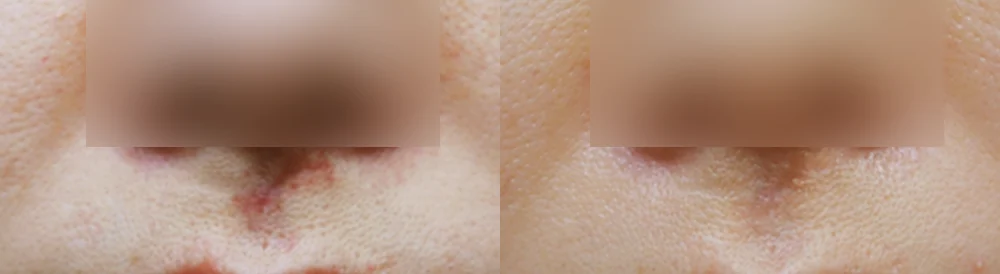 사고 흉터 시술 전후 사진 61 · 보니따의원