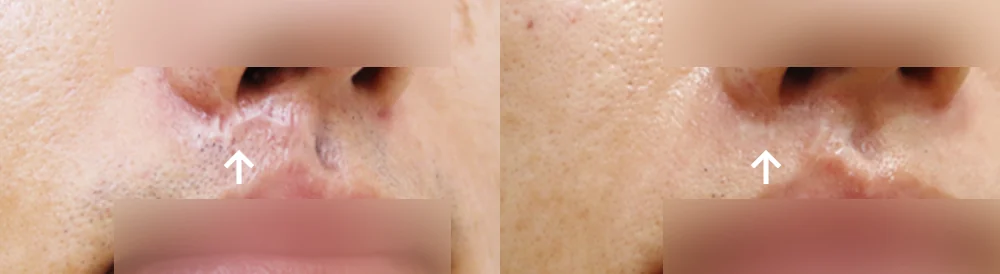 사고 흉터 시술 전후 사진 63 · 보니따의원