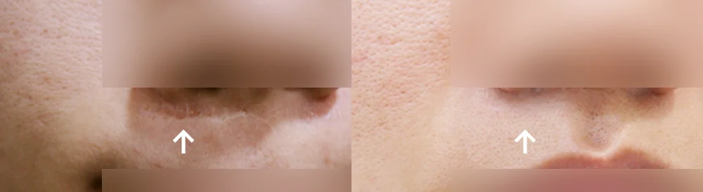 사고 흉터 시술 전후 사진 68 · 보니따의원