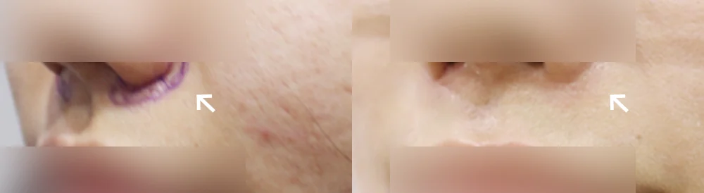사고 흉터 시술 전후 사진 70 · 보니따의원