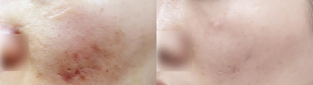 여드름·모공 흉터 시술 전후 사진 8 · 보니따의원