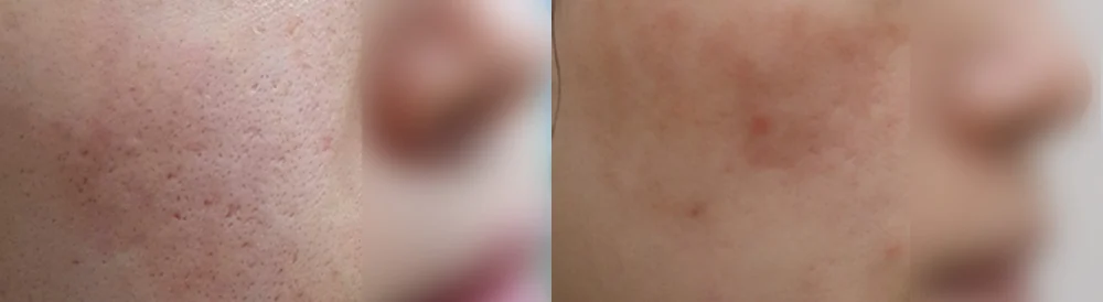 여드름·모공 흉터 시술 전후 사진 9 · 보니따의원