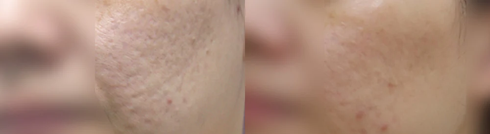 여드름·모공 흉터 시술 전후 사진 12 · 보니따의원