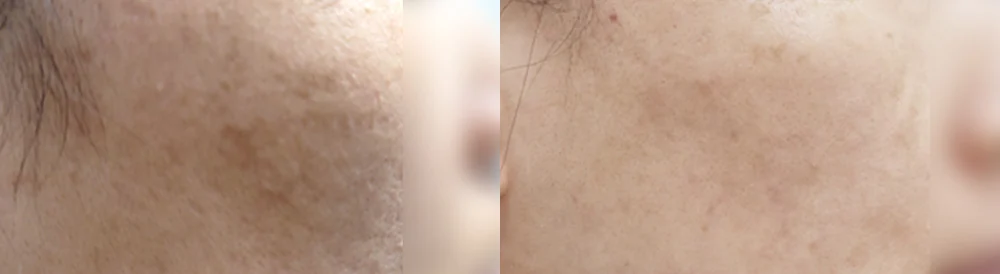 여드름·모공 흉터 시술 전후 사진 15 · 보니따의원