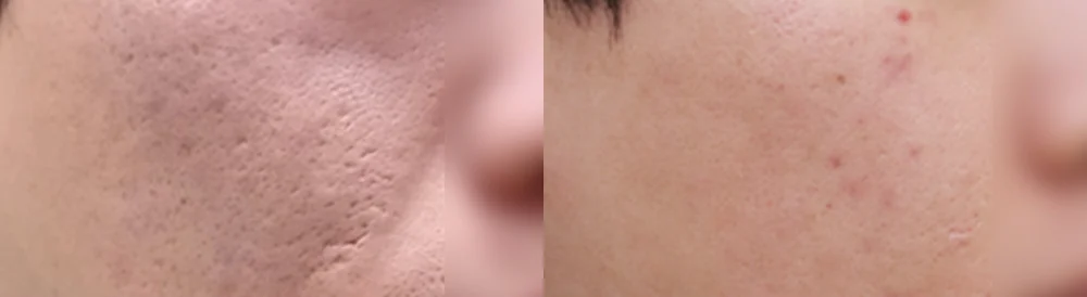 여드름·모공 흉터 시술 전후 사진 17 · 보니따의원