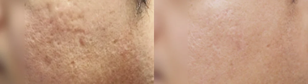 여드름·모공 흉터 시술 전후 사진 19 · 보니따의원