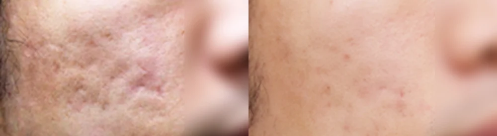 여드름·모공 흉터 시술 전후 사진 21 · 보니따의원