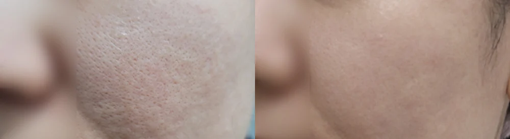 여드름·모공 흉터 시술 전후 사진 27 · 보니따의원