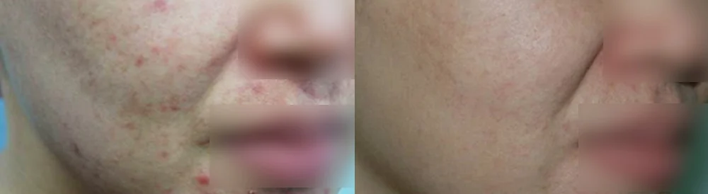 여드름·모공 흉터 시술 전후 사진 29 · 보니따의원