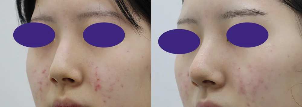 코 성형 시술 전후 사진 16 · 보니따의원