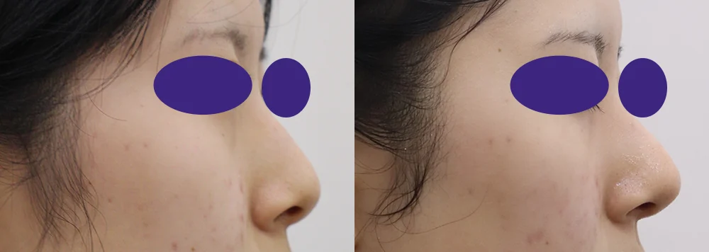 코 성형 시술 전후 사진 19 · 보니따의원