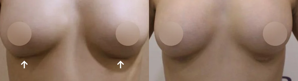 Body Depressed & Incision Scars before & after photo 17 · Bonita Clinic Seoul