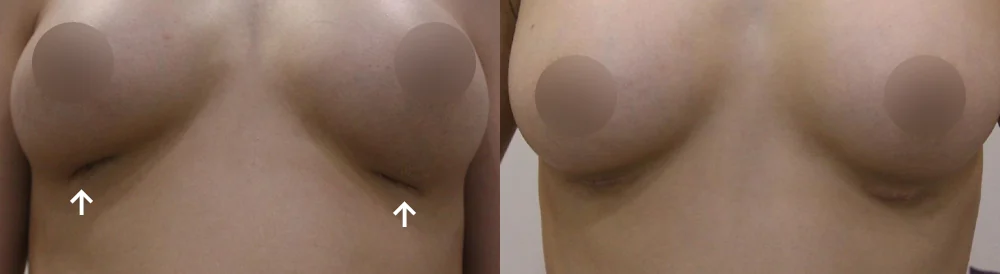 Body Depressed & Incision Scars before & after photo 18 · Bonita Clinic Seoul