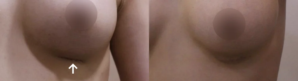 Body Depressed & Incision Scars before & after photo 19 · Bonita Clinic Seoul