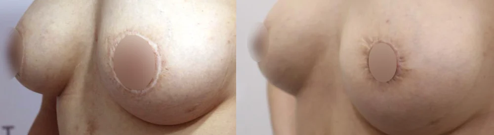 Body Depressed & Incision Scars before & after photo 22 · Bonita Clinic Seoul