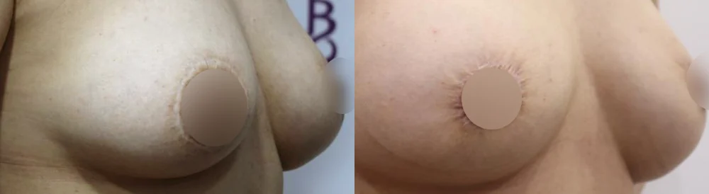 Body Depressed & Incision Scars before & after photo 23 · Bonita Clinic Seoul