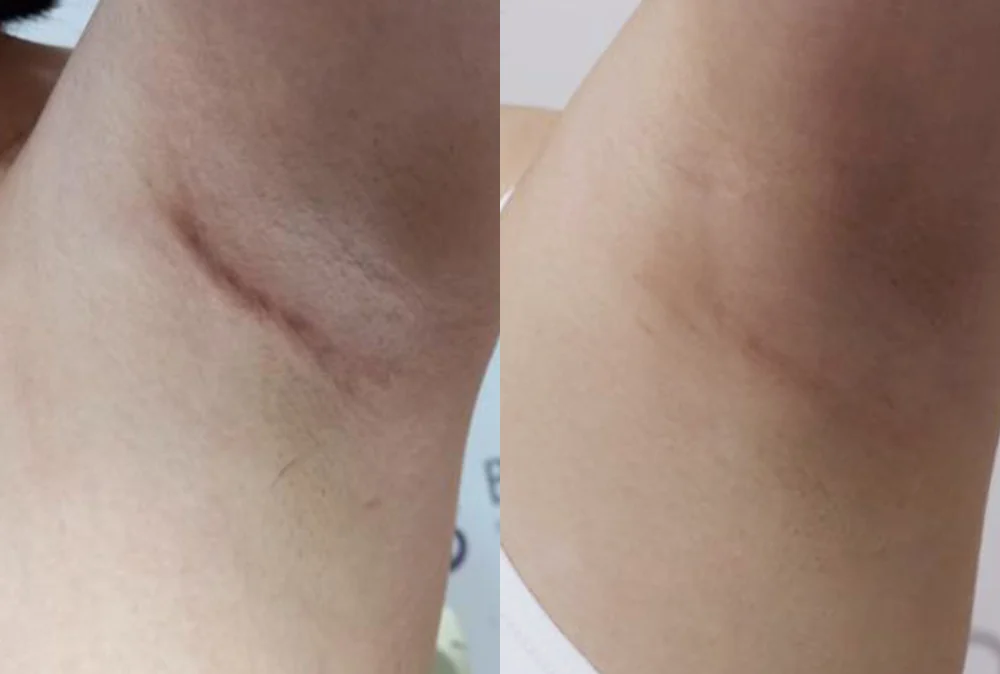 Body Depressed & Incision Scars before & after photo 1 · Bonita Clinic Seoul