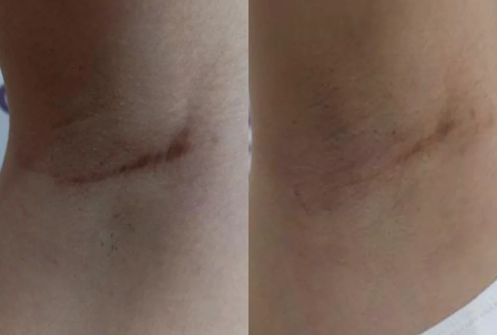 Body Depressed & Incision Scars before & after photo 2 · Bonita Clinic Seoul