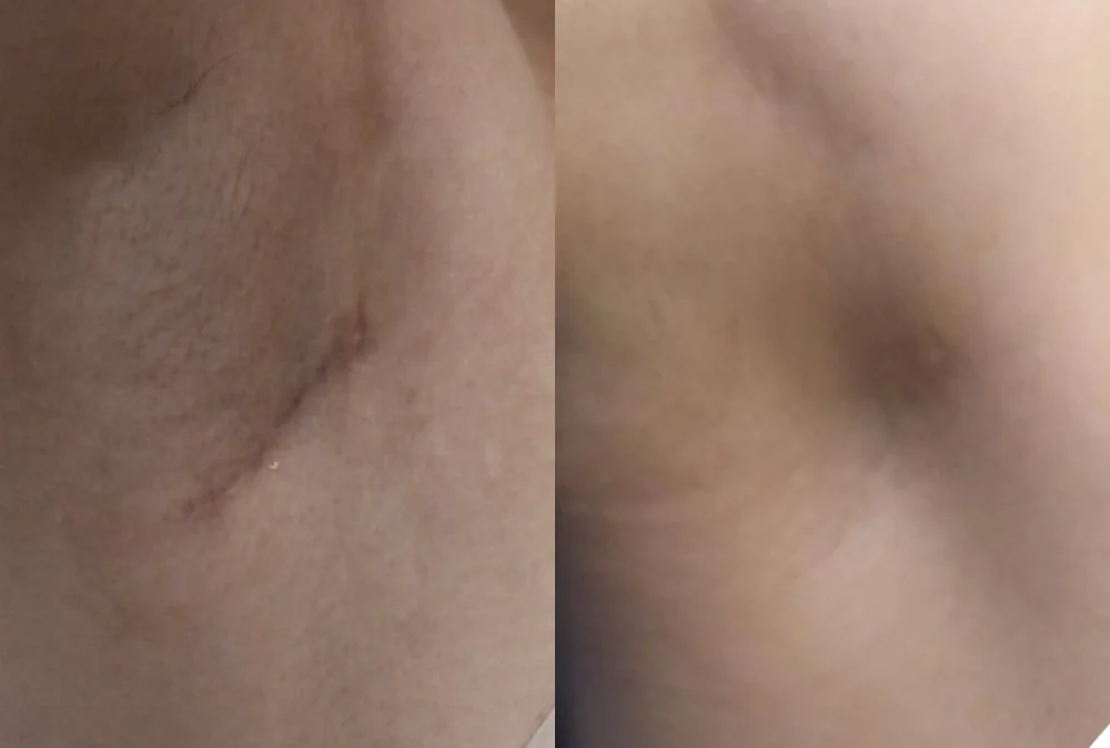 Body Depressed & Incision Scars before & after photo 3 · Bonita Clinic Seoul