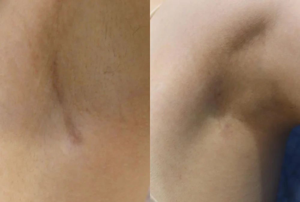 Body Depressed & Incision Scars before & after photo 4 · Bonita Clinic Seoul