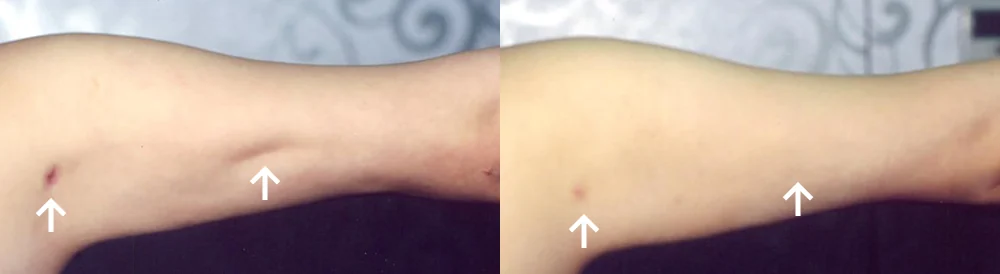 Body Depressed & Incision Scars before & after photo 24 · Bonita Clinic Seoul