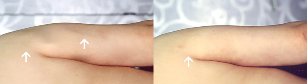 Body Depressed & Incision Scars before & after photo 25 · Bonita Clinic Seoul