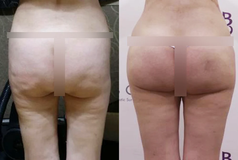 Body Depressed & Incision Scars before & after photo 5 · Bonita Clinic Seoul